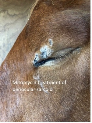 Mitomycin Treatment Periocula Sarcoid