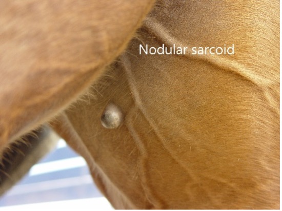 Nodular Sarcoid