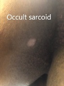 Occult Sarcoid